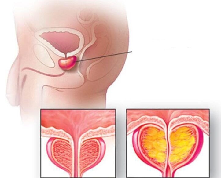 Prostat bezinin yeri, normal prostat ve kronik prostatitte büyümüş