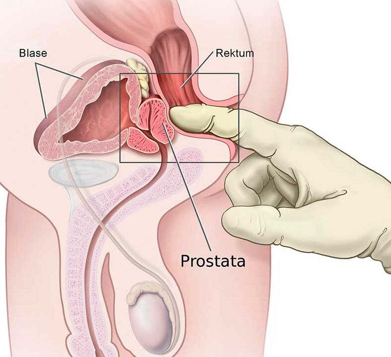 Prostatit için prostat masajı