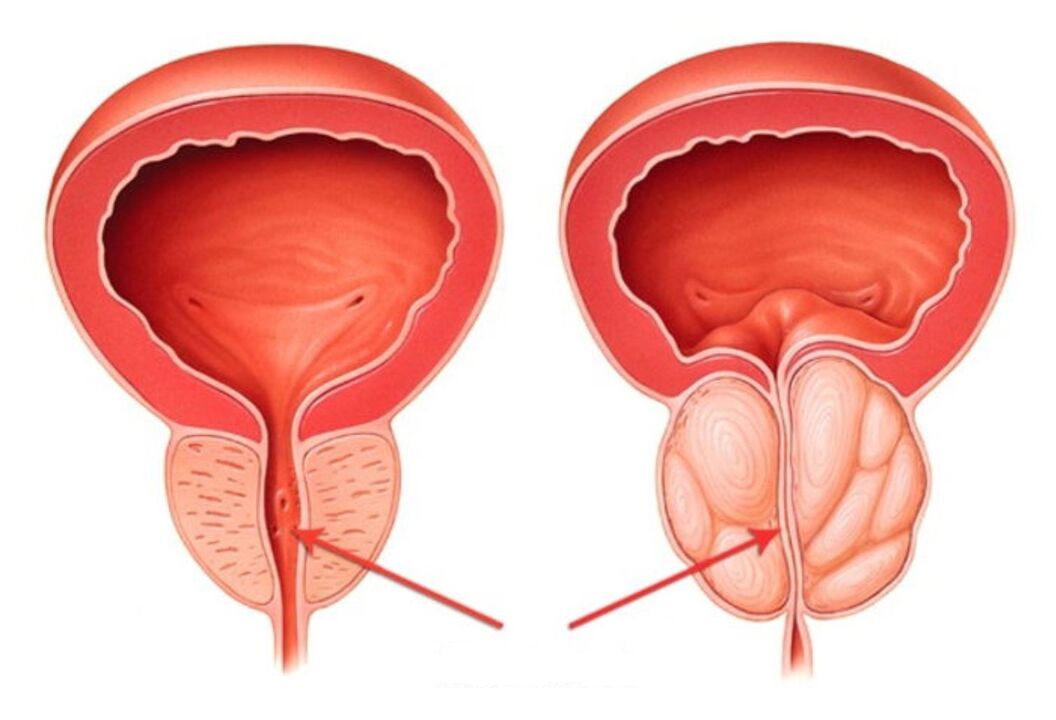 prostatit ile sağlıklı ve iltihaplı prostat